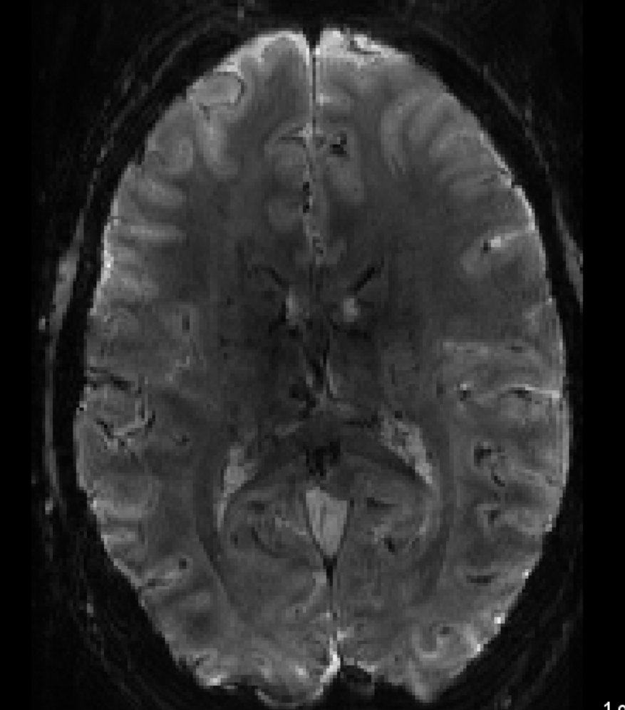 OpenNeuroOrg's tweet image. A new unique dataset is now available at OpenNeuro.org: 0.8mm VASO fMRI data contributed by @layerfMRI. This can become a great benchmark for layer dependent analysis methods openneuro.org/datasets/ds001…