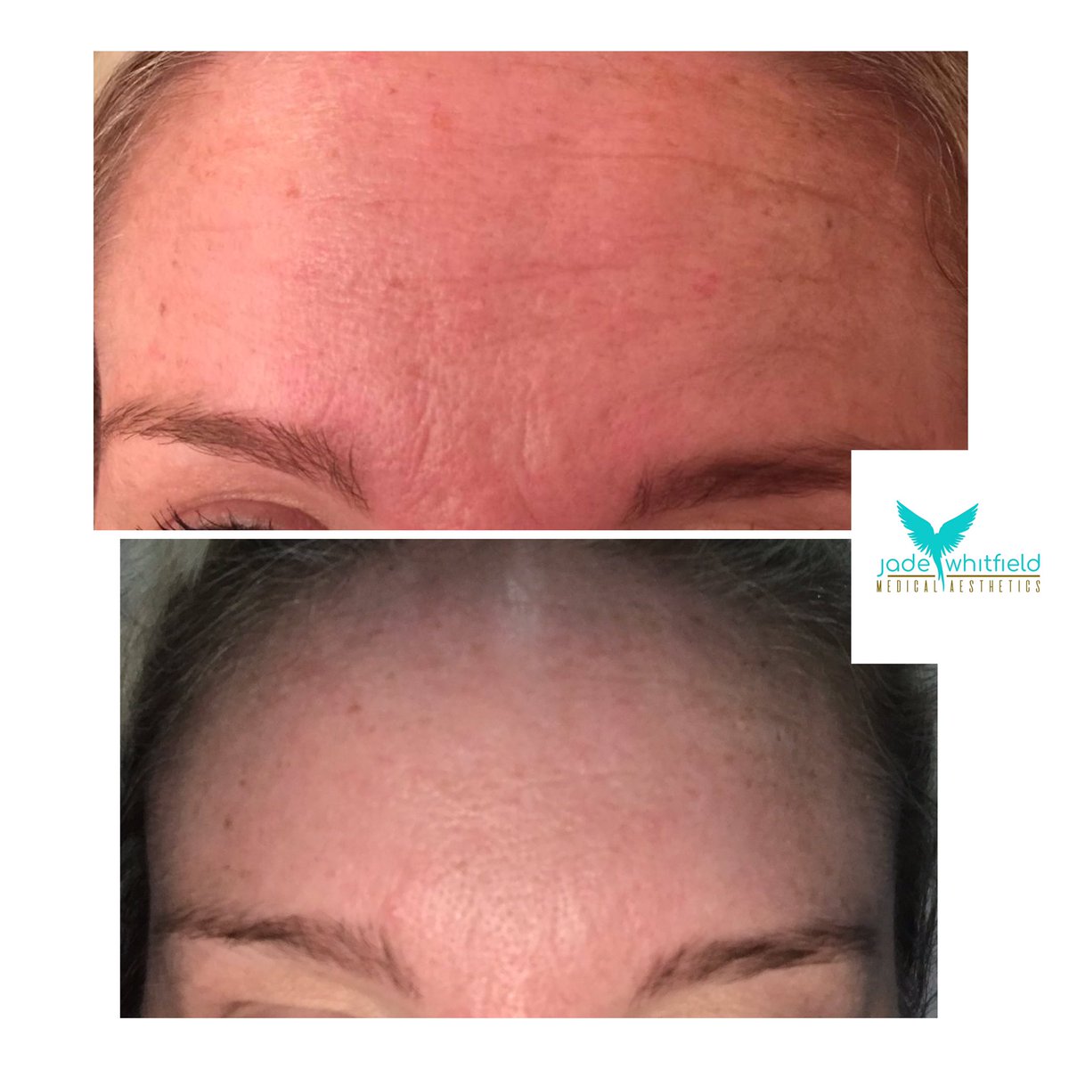 Lovely results at 2 week review, refreshing not changing the look with movement intact 👌 #botox #aesthetics #nurseprescriber #advancednursepractitioner