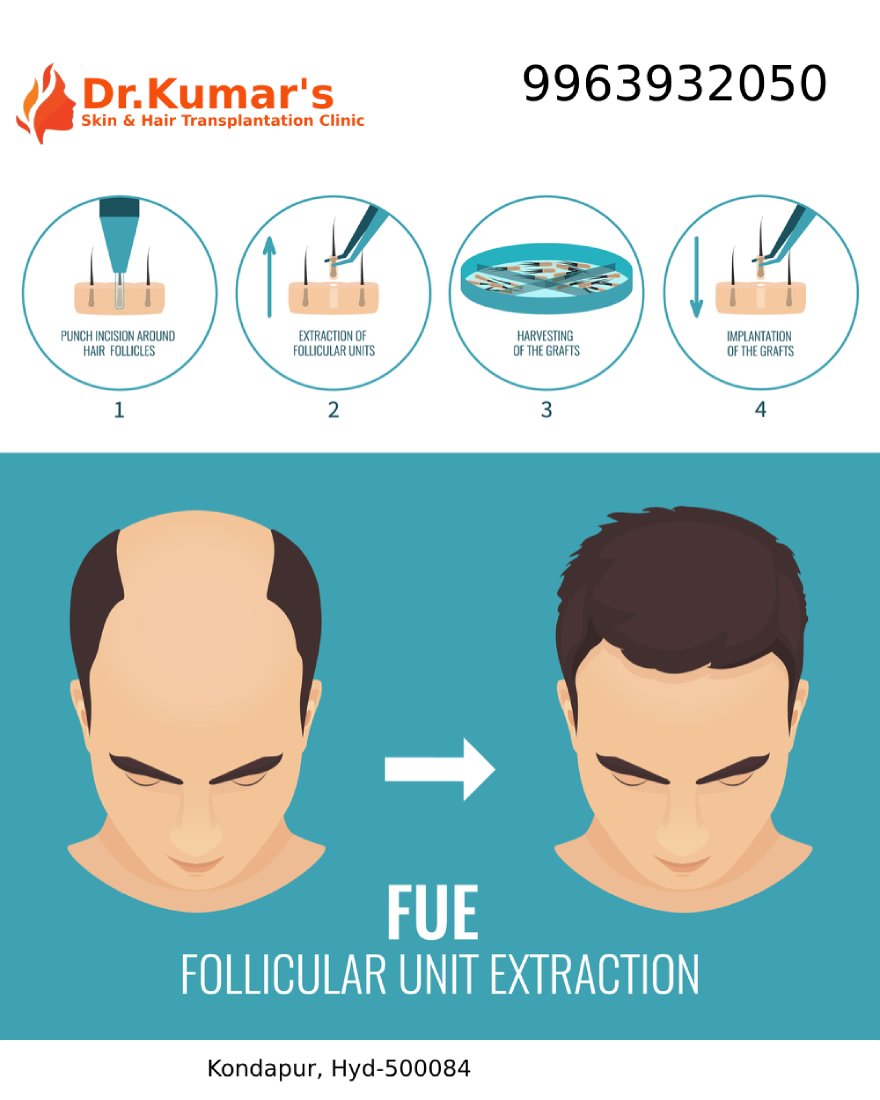 drashokkumar143's tweet image. Hair Transplantation in Hyderabad
thehaircare.co.in
Best Hair Transplantation clinic in Hyderabad. No Pain , 100% Results.
#Hair_Transplant
#Hair_Transplantation_in_Hyderabad
#Hair_Transplantation