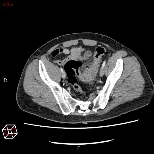 Check out this #Diverticulitis case study (with accompanying CT scan) and tell us what your preferred primary intervention would be and why! #colorectalsurgery