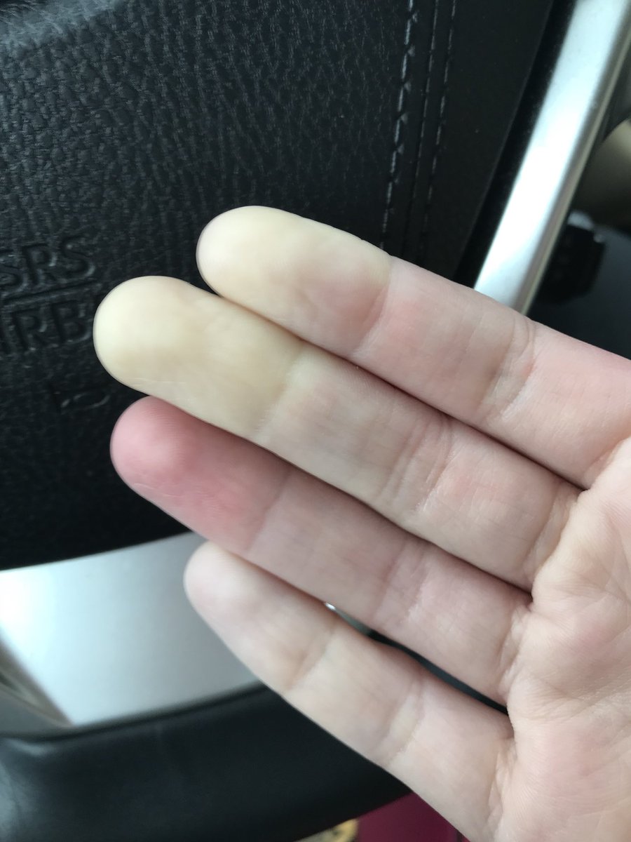 realjulieganas's tweet photo. ‘Tis the season! #raynauds #raynaudsprobs https://t.co/XMEfF6clTx