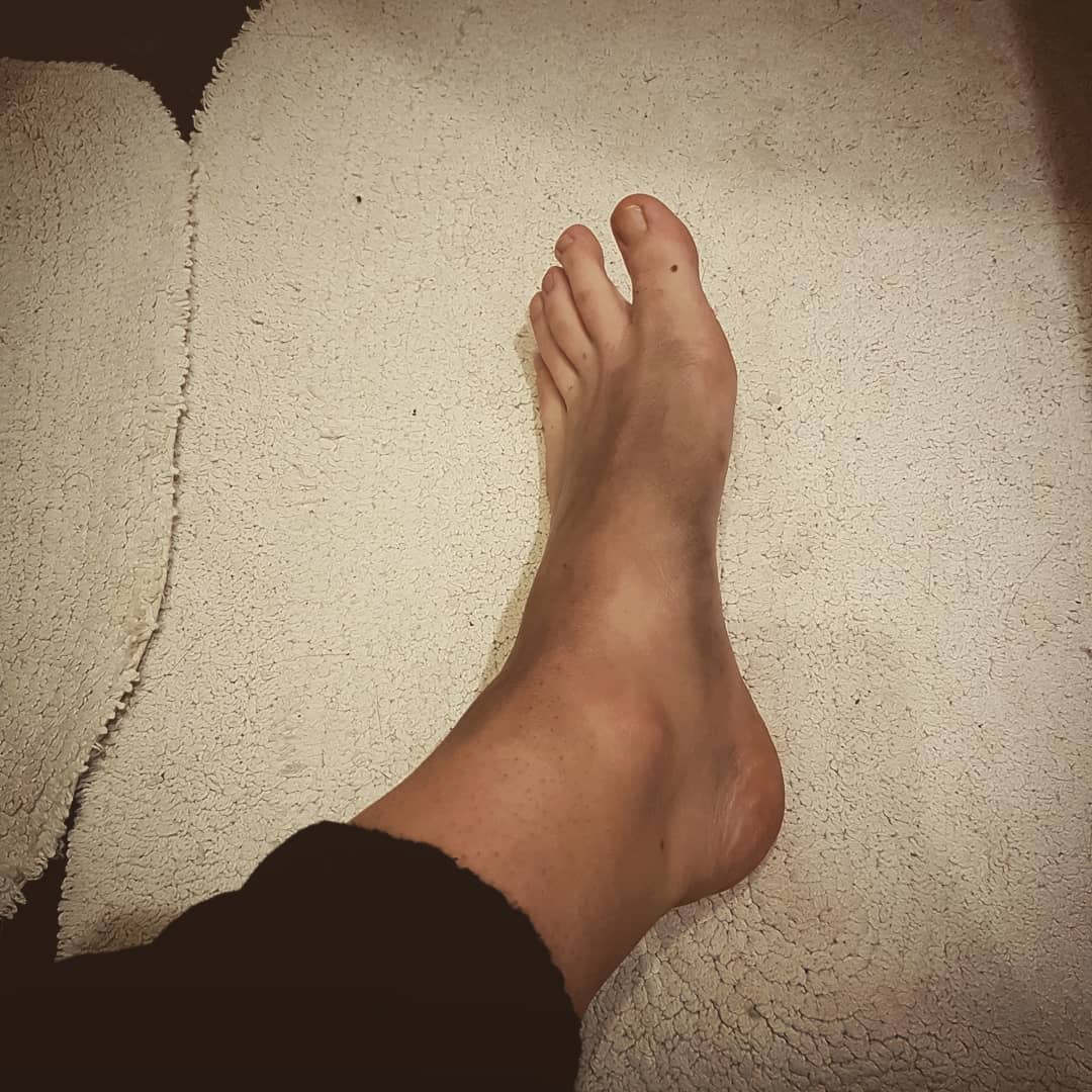 ChiefBrody94's tweet photo. When you have to skate this weekend but your foot is a turnip......π«ππ#bruisewatch #Teamstripes #whoneedstwofeet #hockeylife #zebraproblems https://t.co/KEepCUQ9gZ