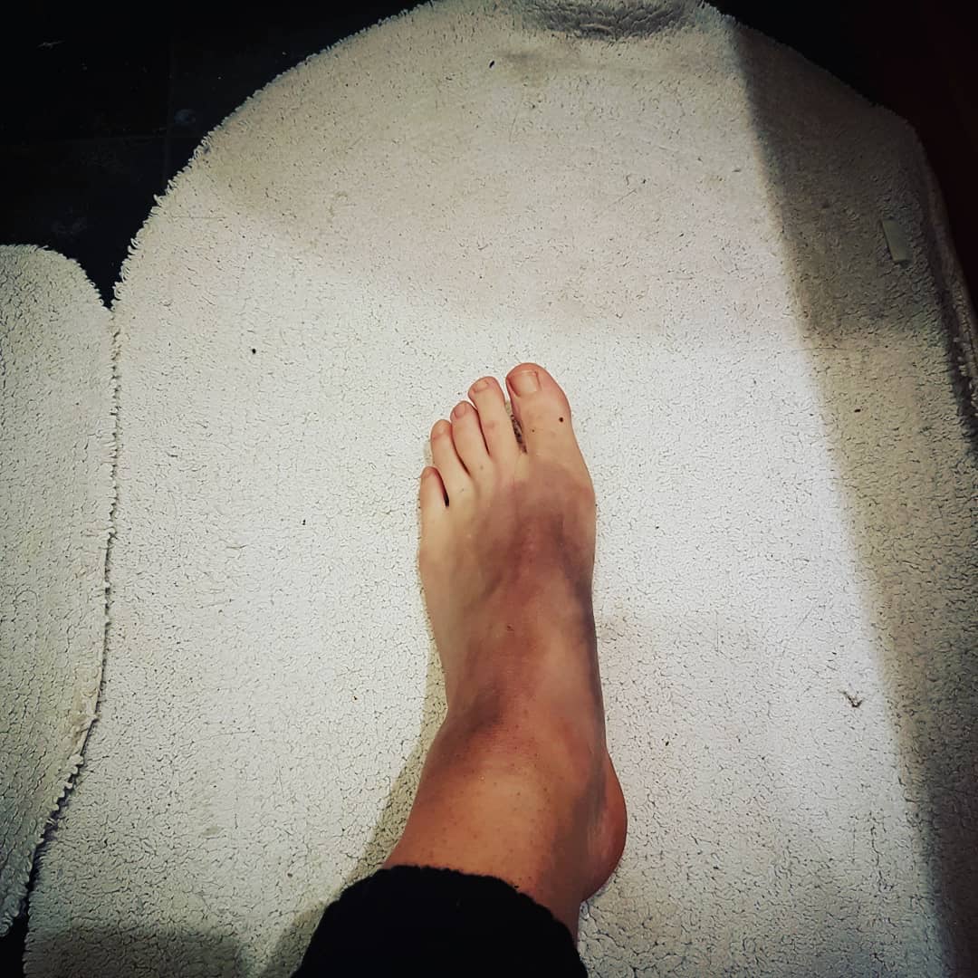 ChiefBrody94's tweet photo. When you have to skate this weekend but your foot is a turnip......π«ππ#bruisewatch #Teamstripes #whoneedstwofeet #hockeylife #zebraproblems https://t.co/KEepCUQ9gZ