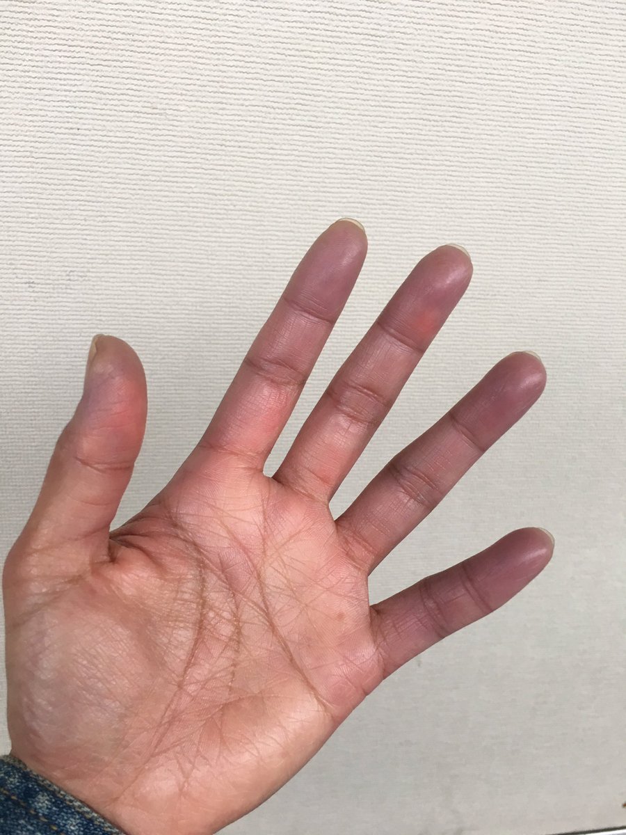 Lupusnaonow 今日は寒い 手が Raynauds レイノー現象