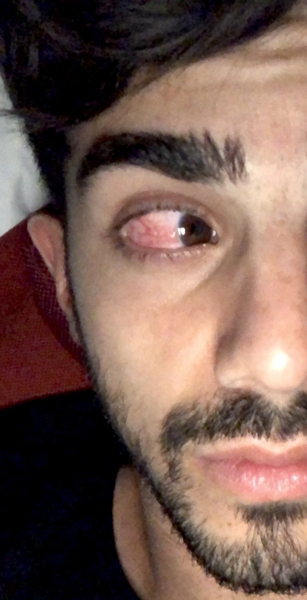 fedevigevani's tweet photo. RT para no tener el ojo asi https://t.co/NwGtWTK7BL