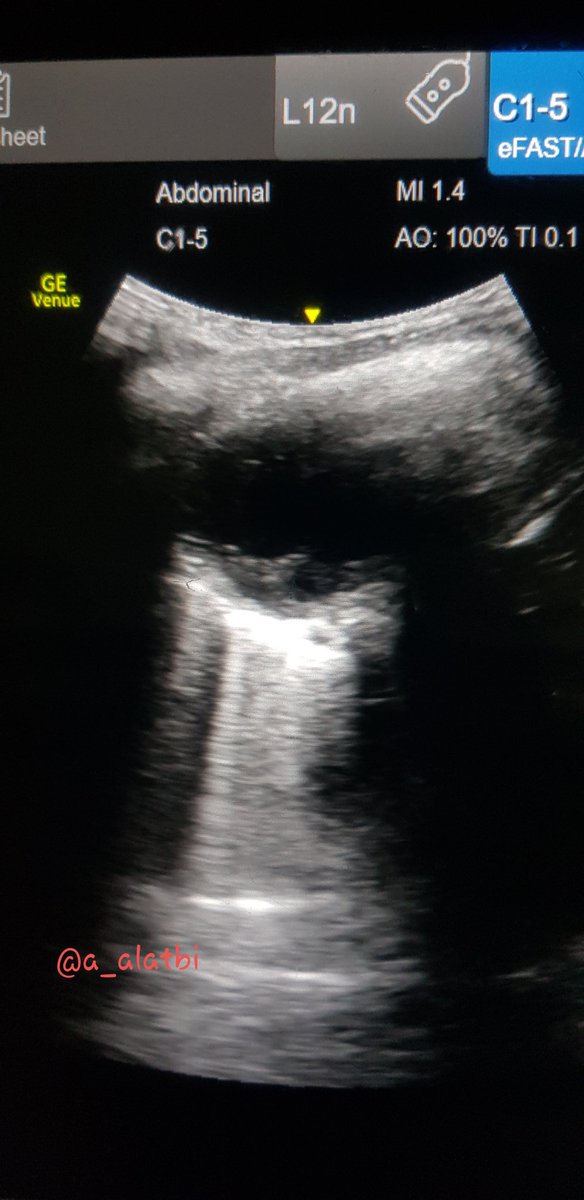 code22breaker's tweet photo. Clear signs of pneumonia on Bedside US
- parapneumatic effusion
-shrivel paper sign/B lines
- thick pleural line 

#CPOCUS
#foamed 
#foamus
#Emergency https://t.co/fi1vuuKVgk