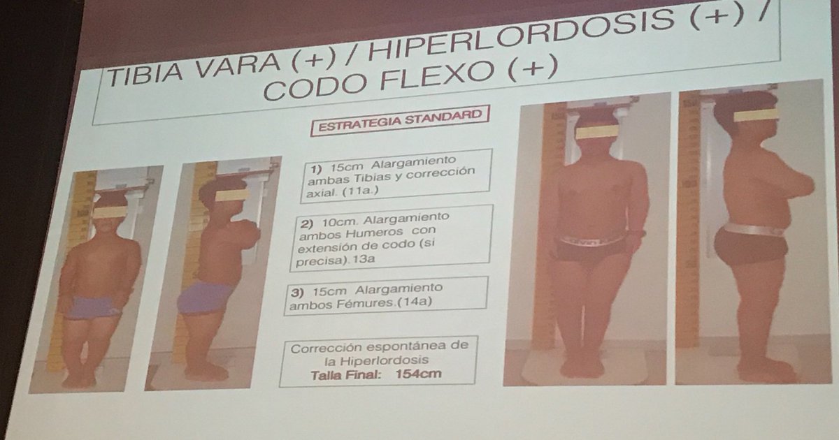 DAR - ICATME (@daricatme) on Twitter photo Talla final media 154cm 2 cirugias en extremidades inferiores 1 en humeros. Menos cirugias, menos osteotomías, menos dolor! Nuestra técnics <a href="/DarIcatme/">DAR - ICATME</a> <a href="/acondroplasia_/">ALPE Acondroplasia</a> Talla final media 154cm 2 cirugias en extremidades inferiores 1 en humeros. Menos cirugias, menos osteotomías, menos dolor! Nuestra técnics <a href="/DarIcatme/">DAR - ICATME</a> <a href="/acondroplasia_/">ALPE Acondroplasia</a>