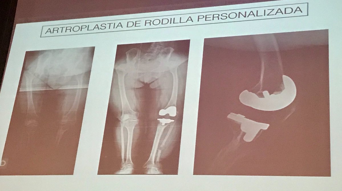 DAR - ICATME (@daricatme) on Twitter photo Protesis personalizadas para pacientes adultos con #displasiasoseas. <a href="/DarIcatme/">DAR - ICATME</a> seguimiento integral del paciente durante todas las etapas de la vida. <a href="/acondroplasia_/">ALPE Acondroplasia</a> #congresoalpe2008 Protesis personalizadas para pacientes adultos con #displasiasoseas. <a href="/DarIcatme/">DAR - ICATME</a> seguimiento integral del paciente durante todas las etapas de la vida. <a href="/acondroplasia_/">ALPE Acondroplasia</a> #congresoalpe2008