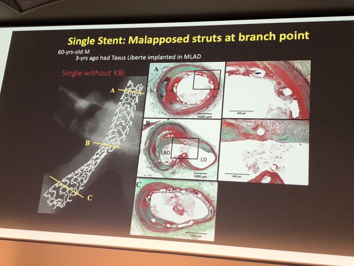 stefan_harb's tweet photo. Reinu Virmani offering exciting insights to shear stress and plaque distribution #EBC2018 https://t.co/P4fLhVUpaU