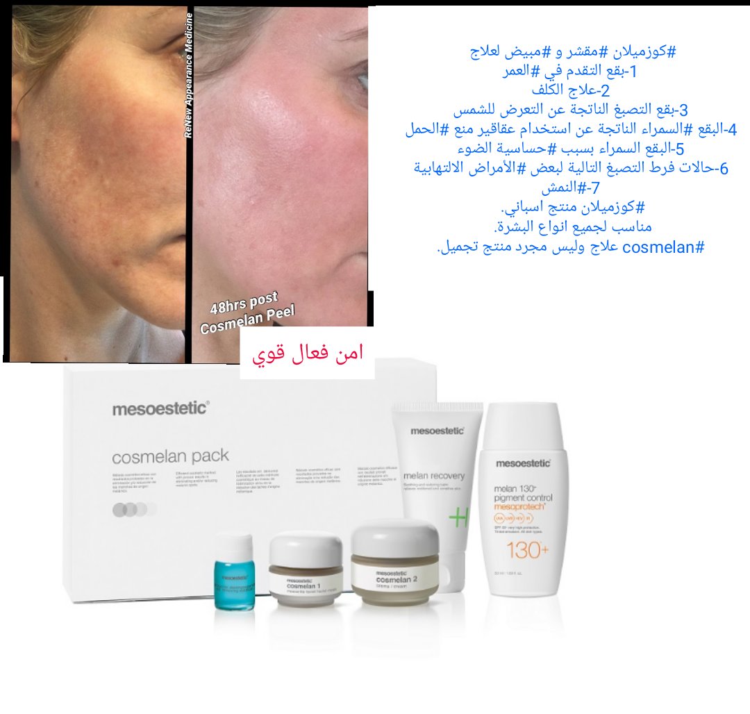 DermamelanMask's tweet photo. #كوزميلان منتج اسباني. 
مناسب لجميع انواع البشرة. 
#cosmelan علاج وليس مجرد منتج تجميل.
 كوزميلان للتخلص نهائيا من تصبغات البشرة والاسمرار في الوجه والرقبة. https://t.co/MTZ1Dj6OdS