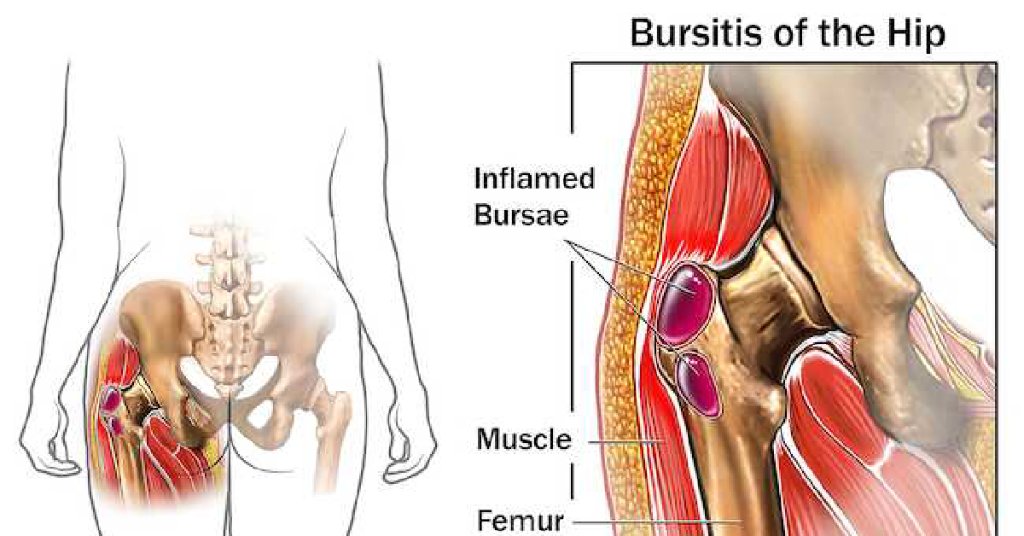 bursitis torna a legjobb kenőcs a csípőízület artrózisához