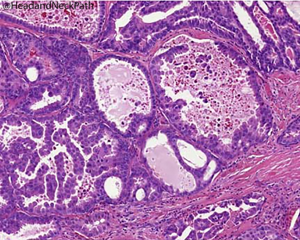HeadandNeckPath's tweet photo. The molecular findings in Intraductal Carcinoma of salivary glands: NCOA4-RET and TRIM27-RET fusions (17 cases): https://t.co/gXpCEISSvC #HNPJ #HeadandNeckPath #Pathology #ENTPath #PathologyTweet #AJSP https://t.co/YphF98f31k