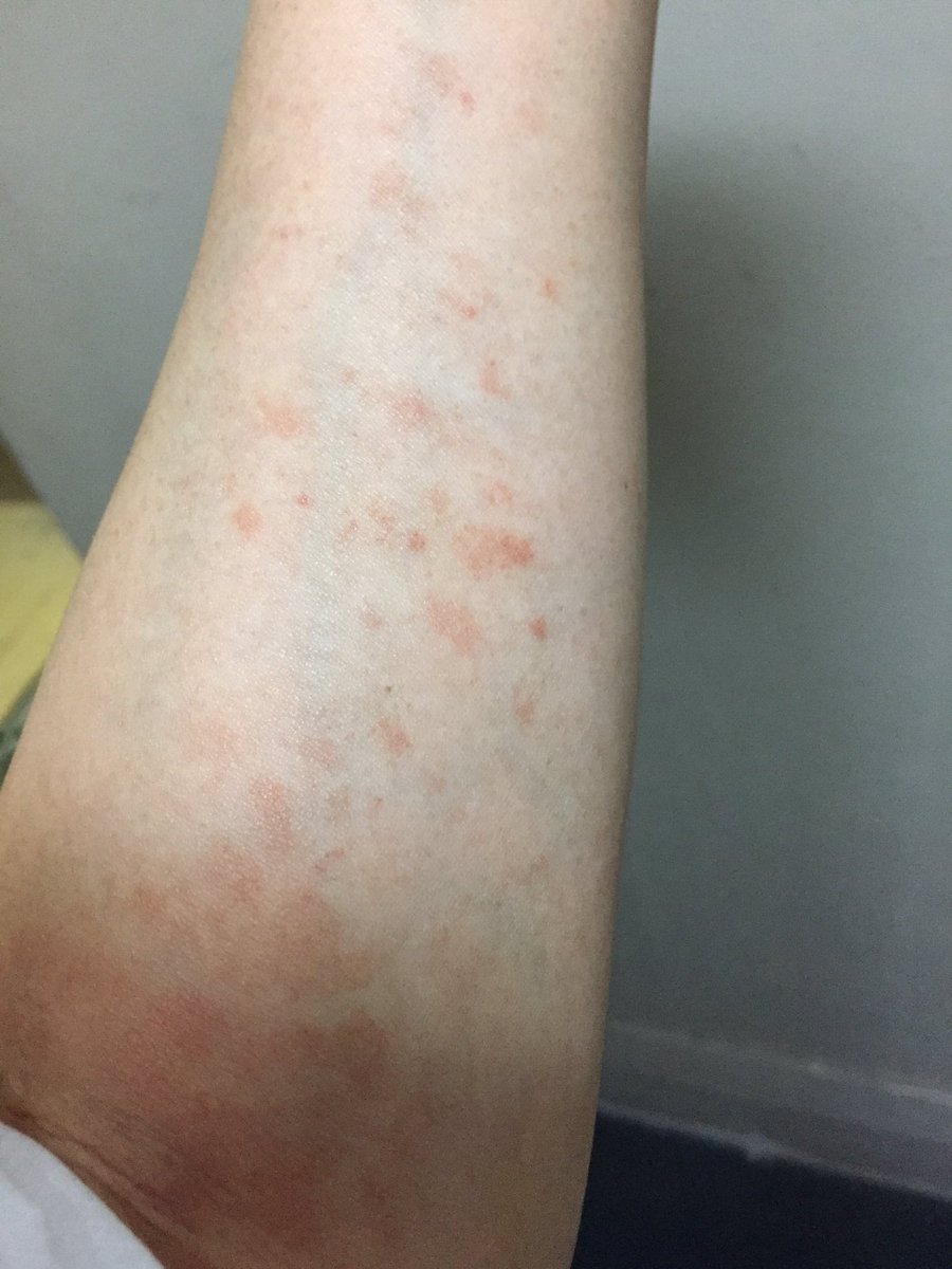 めいこ בטוויטר 左足の親指の付け根の青タンは走る時に痛かったからなんとなくそうかと思ったけど 両腕のの赤い斑点は なんじゃこりゃ と松田優作ばりにおののいた