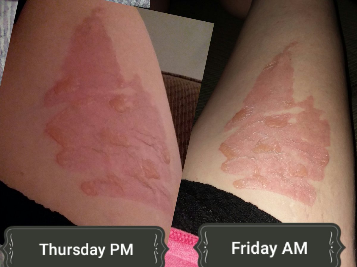 MystiLinne's tweet photo. This is my right thigh. I have thermal burns after opening my #instantpot after the pressure had been released on soup. Thankfully, I reacted quickly or it could have been much worse. https://t.co/QgWbFMYizn
