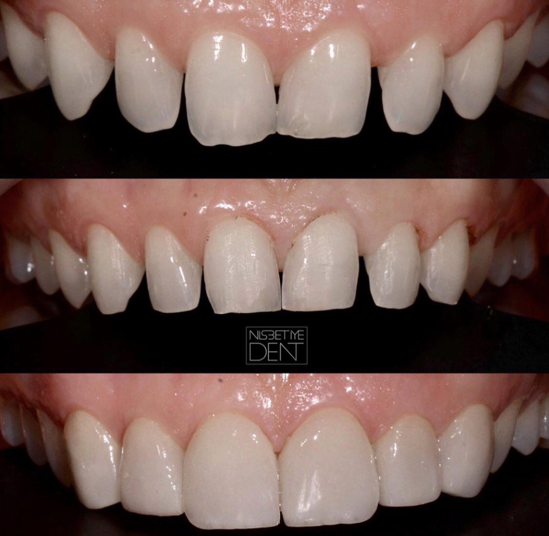 10 emax Lamina
Doğal olsun, ‘sahte’ durmasın, herşeyi çiğneyebilsin 😉

10 emax laminate veneers
Very Natural, high chewing ability😉
‘LESS IS MORE’ ✌️
#laminateveneer#emax#estheticdentistry#dentalesthetics#dentaltreatment#lamina