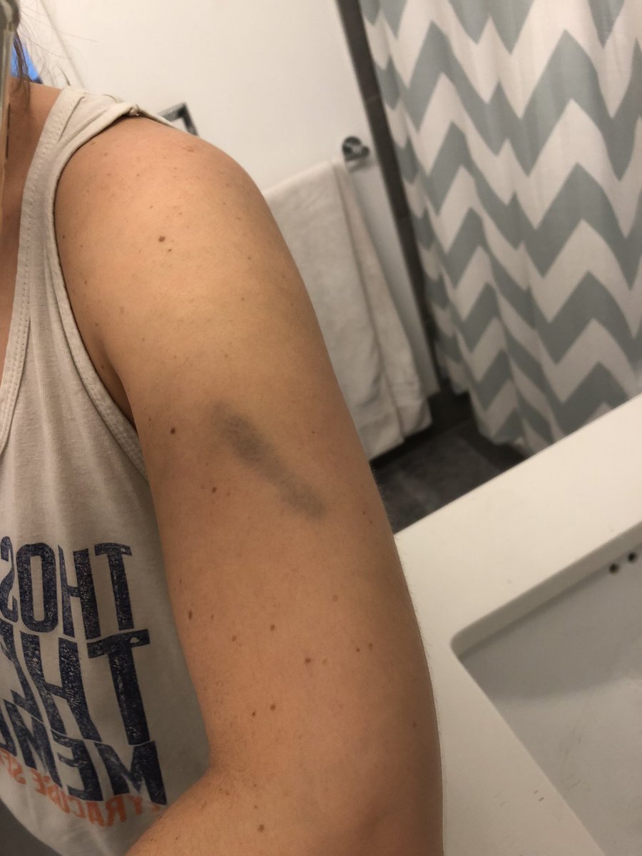 theritebite's tweet photo. A fence fell on me yesterday outside of the Bedford L stop while @MTA employees were working - not one employee asked if I was okay or even apologized for a huge fence falling on me. Woke up with a massive bruise... add this to the list of why @MTA sucks. You’re lucky I don’t sue https://t.co/B1XAyPKFP5