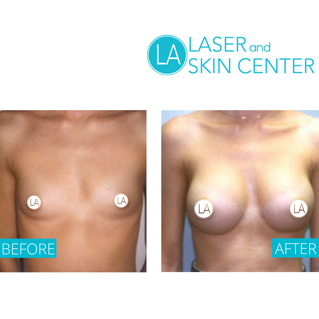 LALaserCenter's tweet photo. Every body is different, so we have different implants- Saline Implants, Structured Saline Implants, Silicone Implants, Gummy Bear Implants, Round Breast Implants, Smooth Implants and Textured Implants! For a one on one consultation, call (800)501-3376 today! #body https://t.co/fqXTIqVwle