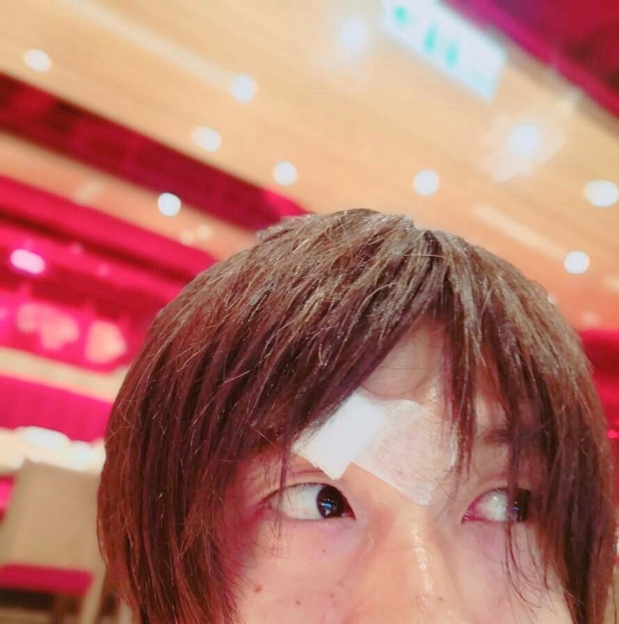 稲田将人 おはよーございます 何故か海外出張中にまゆげを5針縫うことになりました ただホテルで仕事の荷物をみながら歩いてたら柱にぶつかっただけで 全然元気ですが お恥ずかしい 苦笑 稲田将人 おはよーございます 何故か海外出張中にまゆげを5針縫うことになりました ただホテルで仕事の荷物をみながら歩いてたら柱にぶつかっただけで 全然元気ですが お恥ずかしい 苦笑