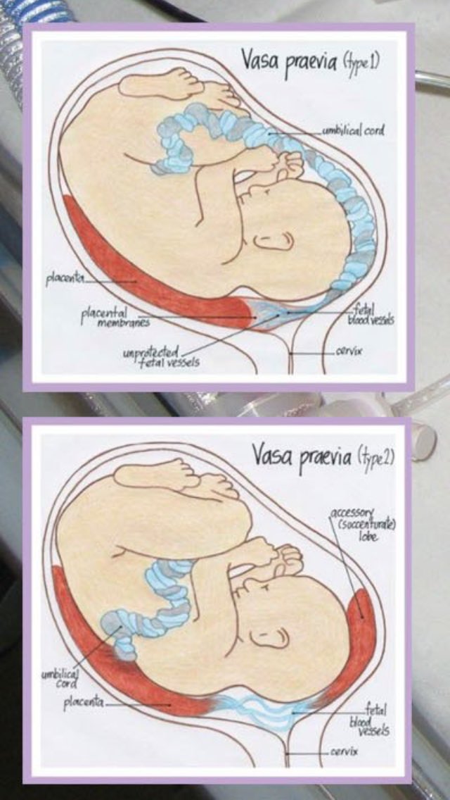 lucybrad's tweet image. Raising awareness of #vasapraevia #vasaprevia during #blaw2018