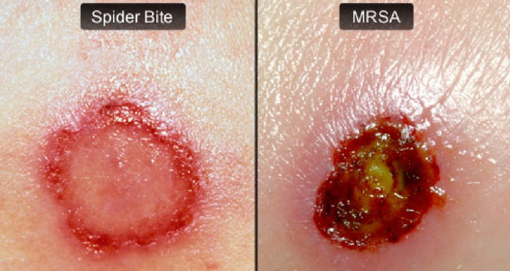 bed bug rashes