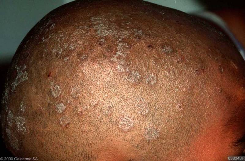tinea capitis scalp fungus pictures