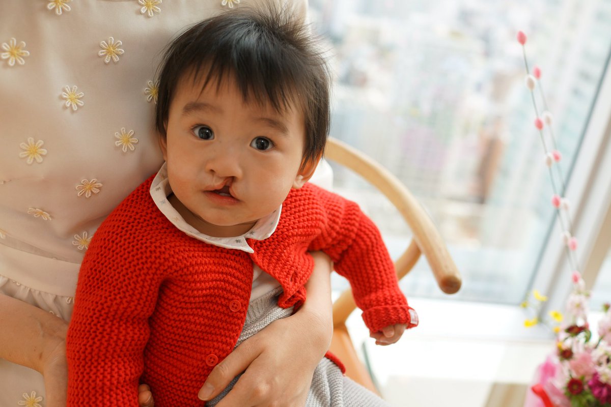 落合陽一さんが息子さんの口唇口蓋裂について生後まもなく公表 以降なぜ写真を撮ってsnsにあげるのかについて 当事者の救いになる と理由を語る Togetter 落合陽一さんが息子さんの口唇口蓋裂について生後まもなく公表 以降なぜ写真を撮ってsnsにあげるのかについて 当事者の救いになる と理由を語る Togetter