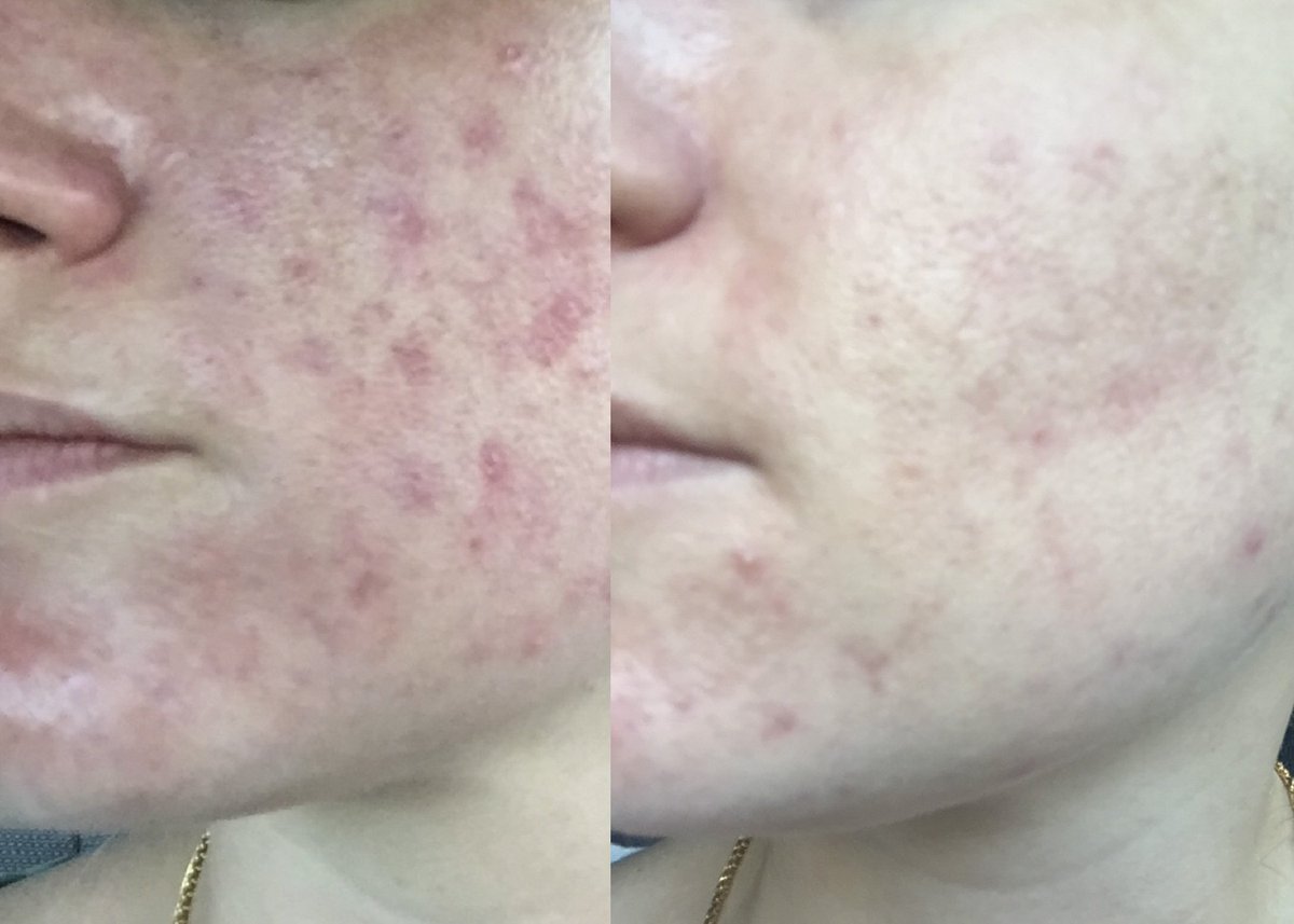 #didyouknow AlumierMD has 6 professional peels that address all skin concerns such as aging, discolouration, sensitive/rosacea and acne prone skin! Look at these amazing results done by @tinaelio_antiaging_laserclinic