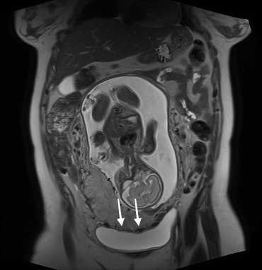arsmedicaPUC's tweet photo. Se reporta el primer caso en Chile de una paciente embarazada con mala inserción placentaria, sometida a cesárea y de cómo se realizó el manejo del sangrado intraoperatorio, con énfasis en el uso de #CellSaver como técnica ahorradora de sangre. https://t.co/YJjo1m0q2U https://t.co/66P0OcNXMW