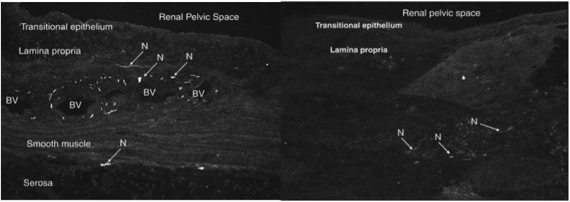 LETTER TO THE EDITOR: Changing the #Paradigm in #RenalDenervation: Is #Transurethral Access the Key to Effective #BloodPressureReduction? by <a href="/nachiketjpatel/">Nachiket Patel</a> et al. bit.ly/2AcsWOO (original study: bit.ly/2J3Frz3)