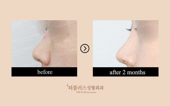 裁断済】鼻形成術 ジョン・ジェヨン 【公式通販】