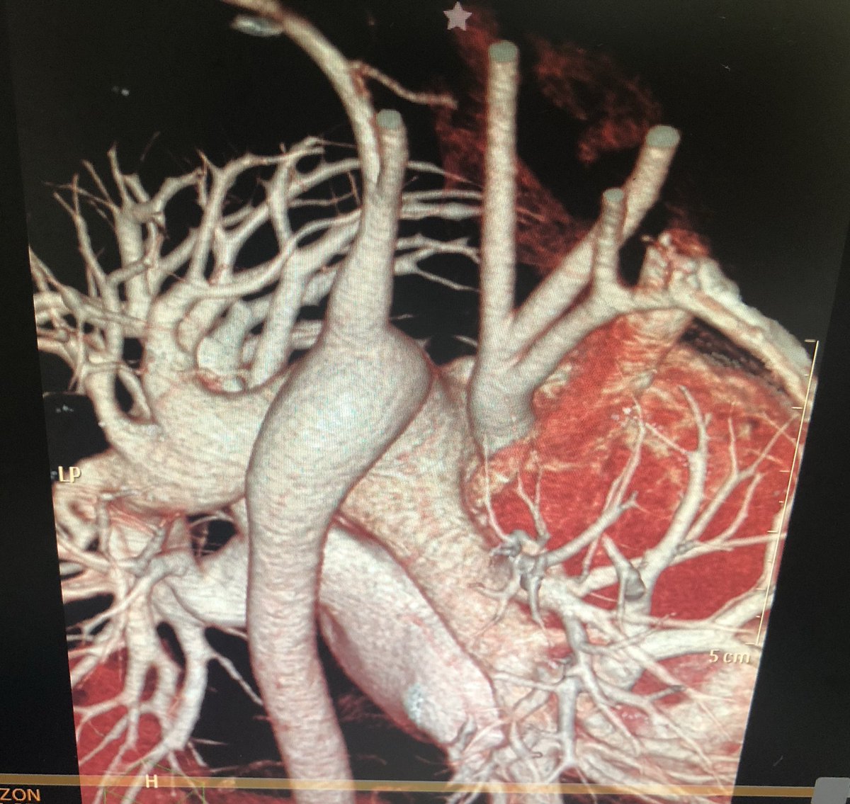 LaLoTomas3's tweet image. ¿Interrupción del arco aórtico tipo B o tipo C? Observa el nacimiento de las arterias carótidas #LoViEnLaRaza #CardioPedia @cardioteca @ColCardiolJal @cardioimagenmx