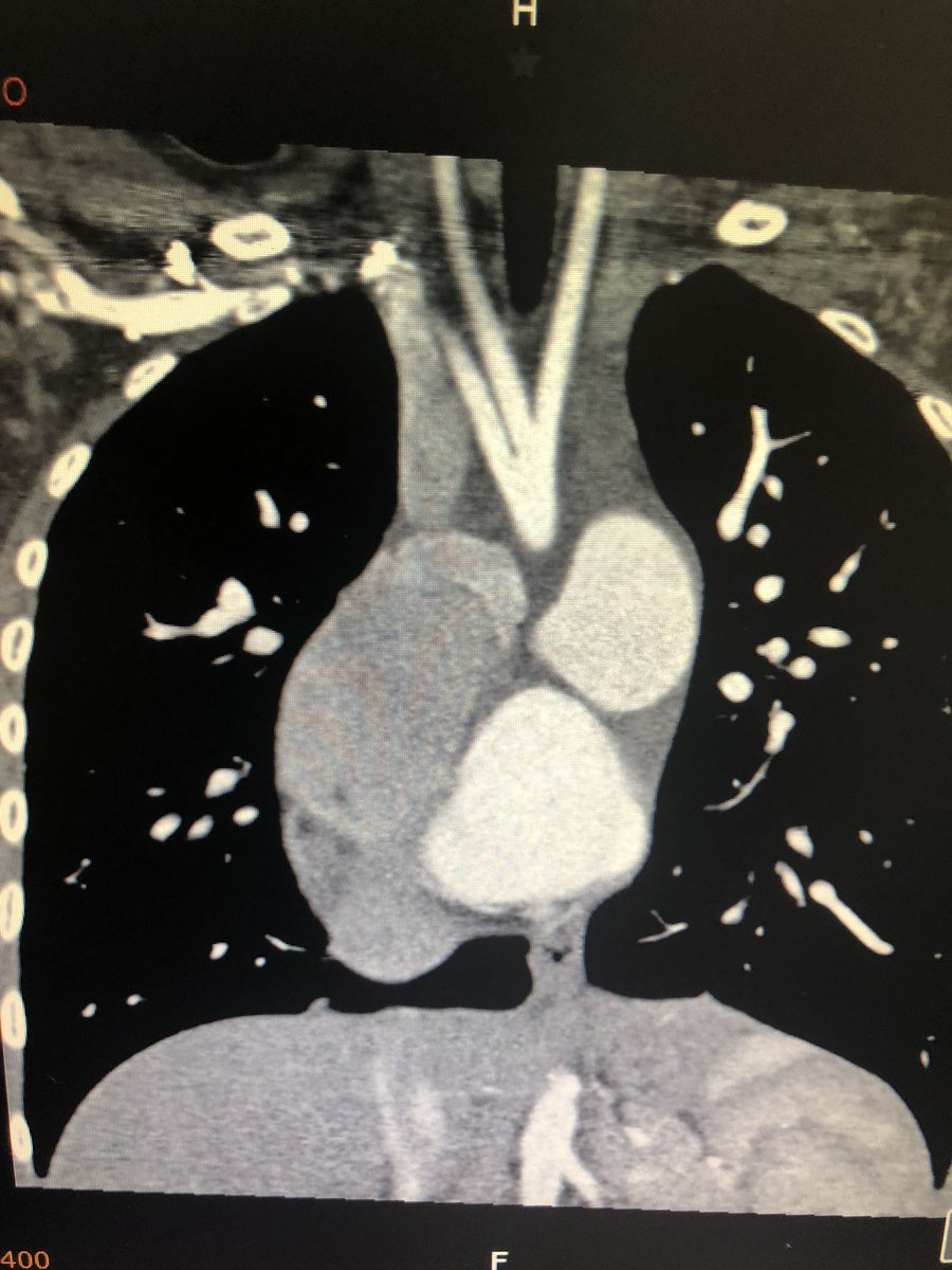 LaLoTomas3's tweet image. ¿Interrupción del arco aórtico tipo B o tipo C? Observa el nacimiento de las arterias carótidas #LoViEnLaRaza #CardioPedia @cardioteca @ColCardiolJal @cardioimagenmx