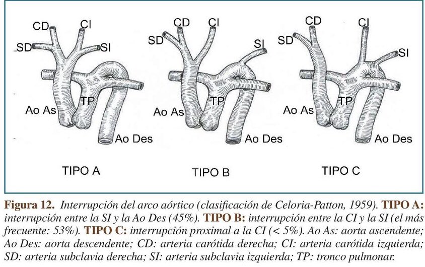 LaLoTomas3's tweet image. ¿Interrupción del arco aórtico tipo B o tipo C? Observa el nacimiento de las arterias carótidas #LoViEnLaRaza #CardioPedia @cardioteca @ColCardiolJal @cardioimagenmx