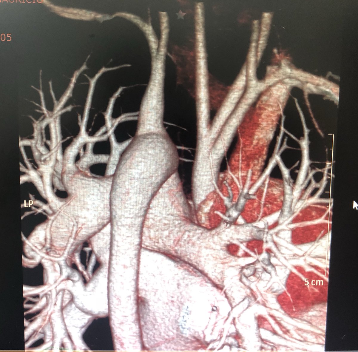 LaLoTomas3's tweet image. ¿Interrupción del arco aórtico tipo B o tipo C? Observa el nacimiento de las arterias carótidas #LoViEnLaRaza #CardioPedia @cardioteca @ColCardiolJal @cardioimagenmx