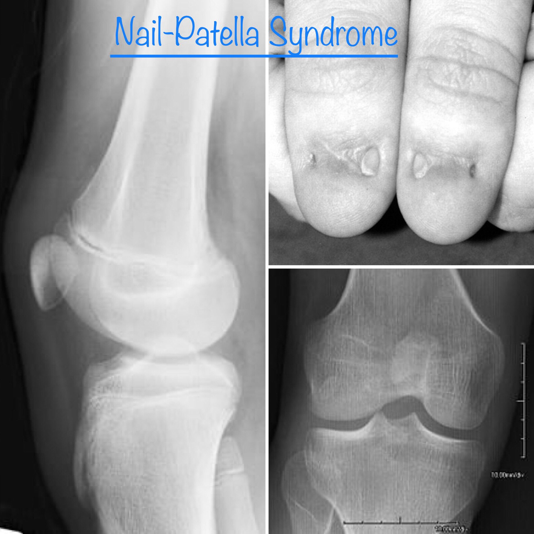 JOSH PERSON... Nail patella syndrome... | Syndrome, Subluxation, Mnemonics