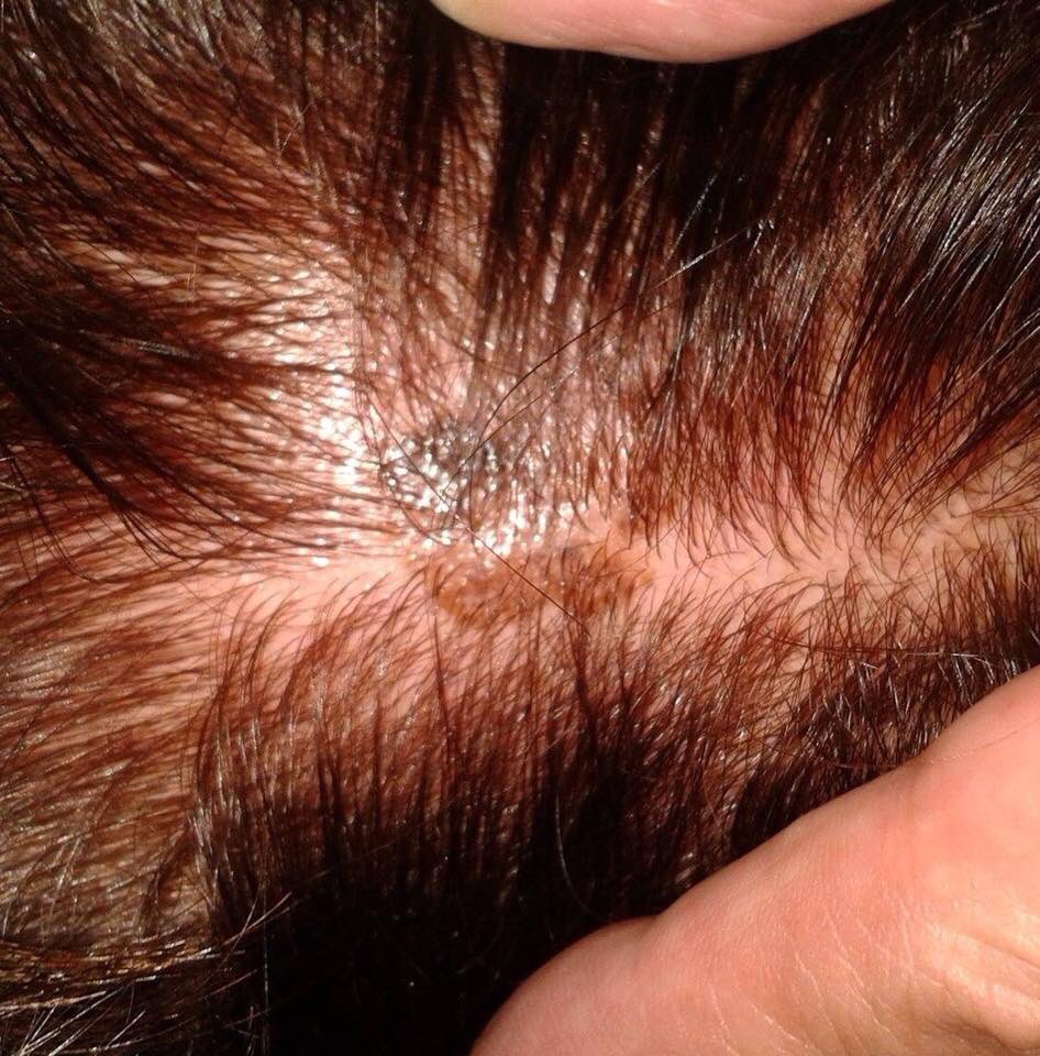 MelanomInfoMID's tweet photo. Der #Friseur als Lebensretter - wenn was auf deinem #Kopf wächst, was da nicht hingehört. Bei der #Melanomerkennung sind nicht nur #Dermatologen wichtig.  #melanom #hautscreening #früherkennung https://t.co/JwFsq78x1X https://t.co/YsQMqA8GCT