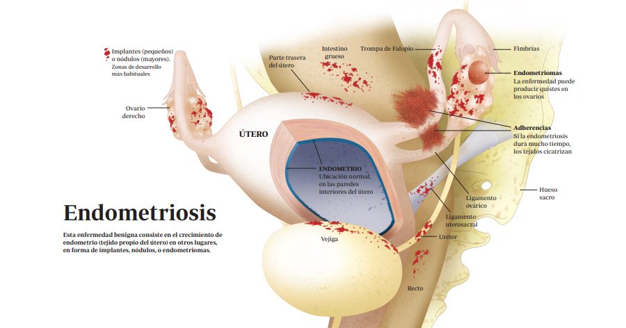 Dieta endometriosis y embarazo