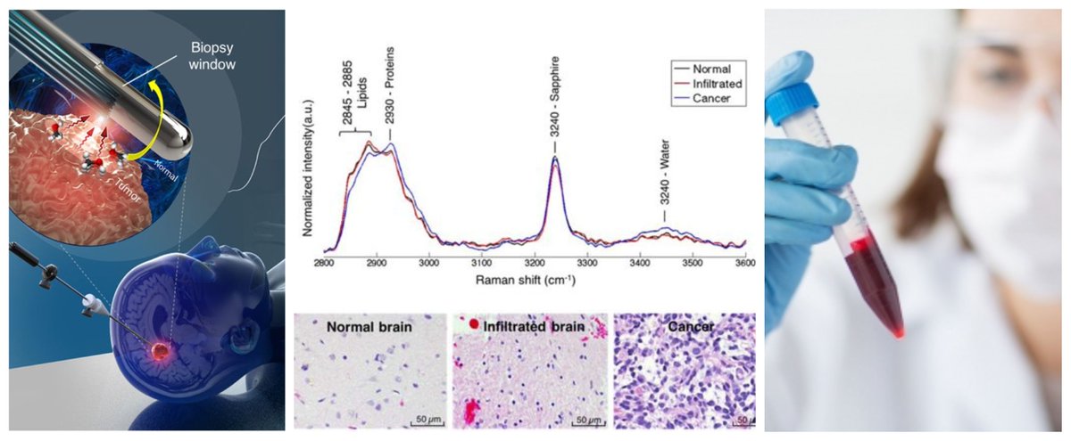pediatricmeet's tweet photo. https://t.co/qIIz2wcSM1 New blood test for pediatric brain tumor patients offers safer approach than surgical biopsies #PediatricSurgery #PediatricOncology #Childhoodtumors #Braintumor 3rd Edition of International Congress on Pediatrics on March 4-5, 2019 at Barcelona, Spain https://t.co/sKaAOyr24C