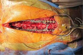 Stemcellmeet's tweet image. GoodBye Spinal Surgery– Welcome Stem Cell Therapy stemcells.alliedacademies.com/europe/ 

#Stem_cell_congress #Stem_cell_conferences #Spinal_surgery #stem_cell_treatments #Therapeutics #therapy #Surgery #Regeneration @ObgynJovanovic @SpinalResearch @Spinalinjury @UnitedSpinal @stemcellthai