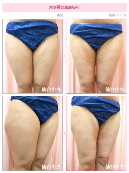 ট ইট র 仙台中央クリニック美容整形美容外科 お尻脂肪吸引 太もも脂肪吸引 ヒップアップ 脂肪吸引仙台 根こそぎ脂肪吸引 脂肪吸引 下半身に脂肪が付きやすい方は ダイエットすると胸がますます小さくなるため 脂肪吸引がお勧めです 脂肪吸引は 内出血