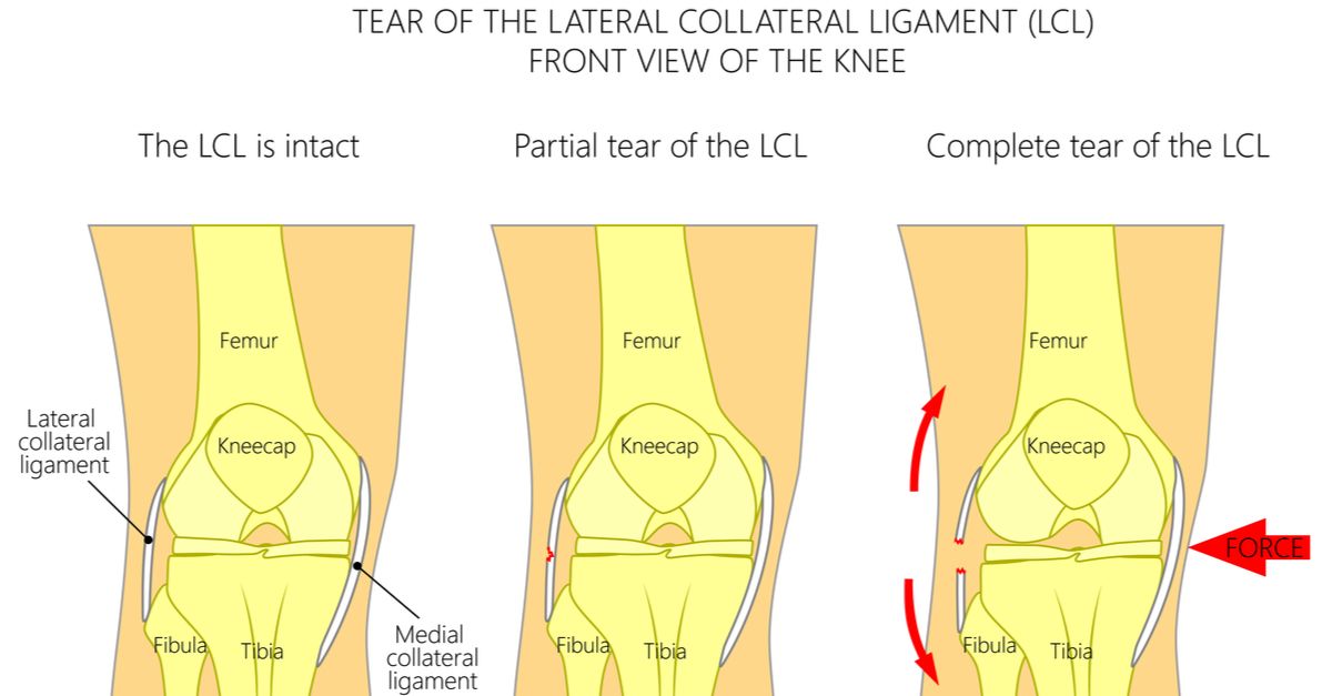 thekneedoc's tweet photo. #LCLsurgery is very effective in restoring side-to-side stability to the #knee and preventing #varus gapping. https://t.co/xAwgth2DqF https://t.co/zrHvUlzNhQ