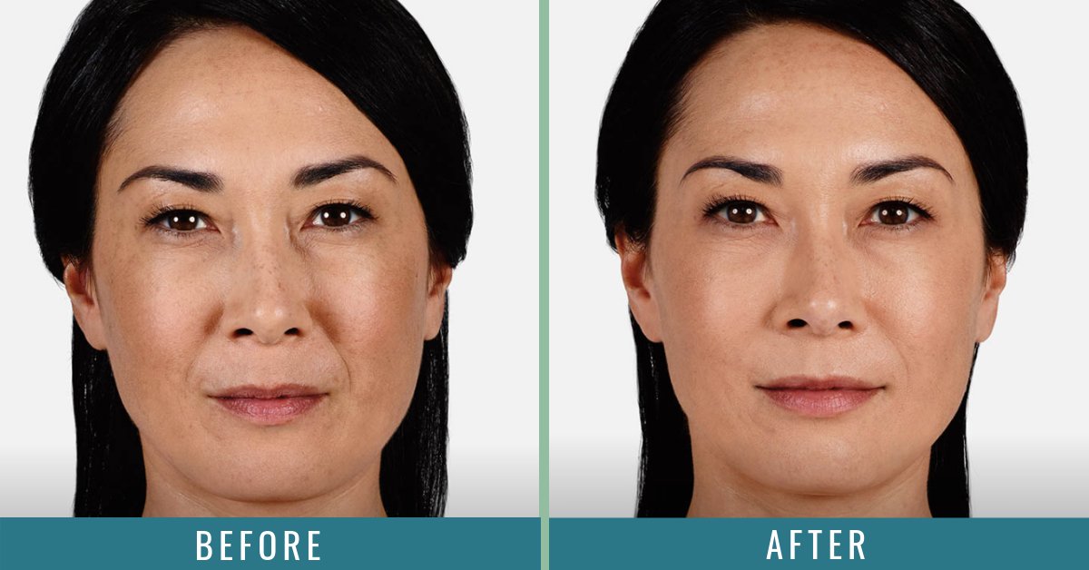 MaryLeeAmerian's tweet photo. Pillowy &amp; Pouty 💉👄 #santamonica #losangeles #beforeandafter #lipfiller #lipplumper #lipinjections #lipaug #lipaugmentation #lipfillers #lipjob #lips #lipslipslips #lusciouslips #fulllips #fullerlips #fatlips #juvedermlips #juvederm #dermalfillers https://t.co/EXTO3HyJeQ
