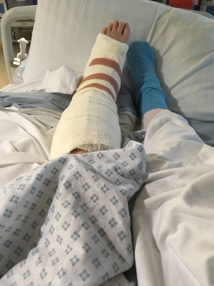 shubush's tweet photo. #LifeWithEDS Still recovering from ankle stabilisation surgery - after years of dislocations. The added pressure on my other joints means more #dislocations & #tendonitis #Ouch #EDS https://t.co/F4SccVnWrK