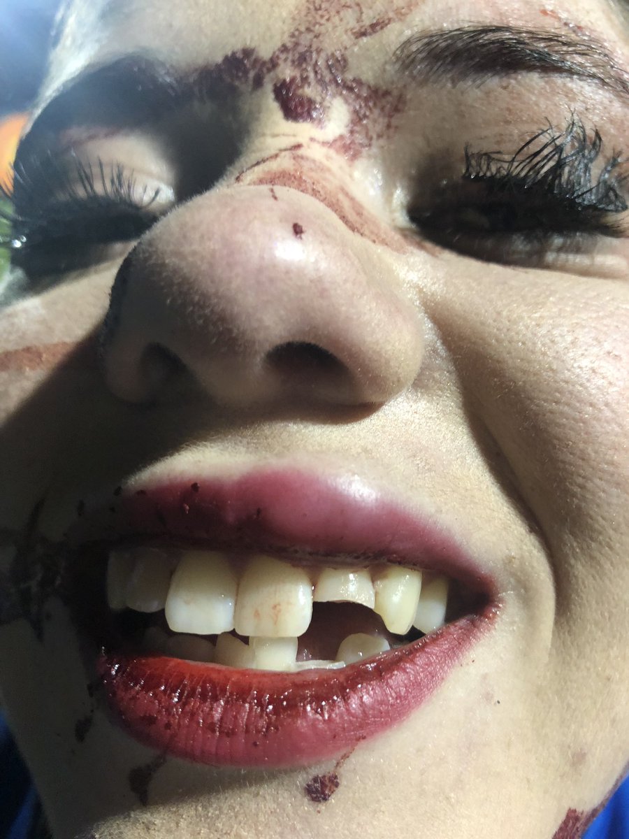 KaleyGilland's tweet photo. I hope you all have a new found respect for what I and my friends do as a part of color guard. There is so much more than just ”flag twirling”. I chipped 2 teeth and got 4 stitches all in one practice. Take some time to appreciate the art that we put on. ❤️ https://t.co/QkNvQSCWto