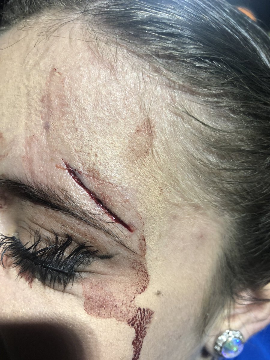KaleyGilland's tweet photo. I hope you all have a new found respect for what I and my friends do as a part of color guard. There is so much more than just ”flag twirling”. I chipped 2 teeth and got 4 stitches all in one practice. Take some time to appreciate the art that we put on. ❤️ https://t.co/QkNvQSCWto