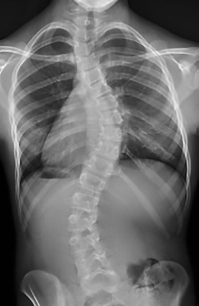 austinjtruex's tweet photo. It's World Spine Day, and all I've got to show for it is my spine-usoidal graph of a back. Thank you scoliosis! https://t.co/pVGZ230d57