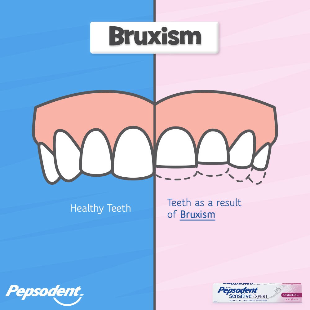 Pepsodent_ghana's tweet image. Teeth grinding, also known as bruxism is an unhealthy habit that can cause tooth sensitivity and other oral health issues. Are you fond of grinding your teeth whether consciously or unconsciously? #PepSensitiveRepairs