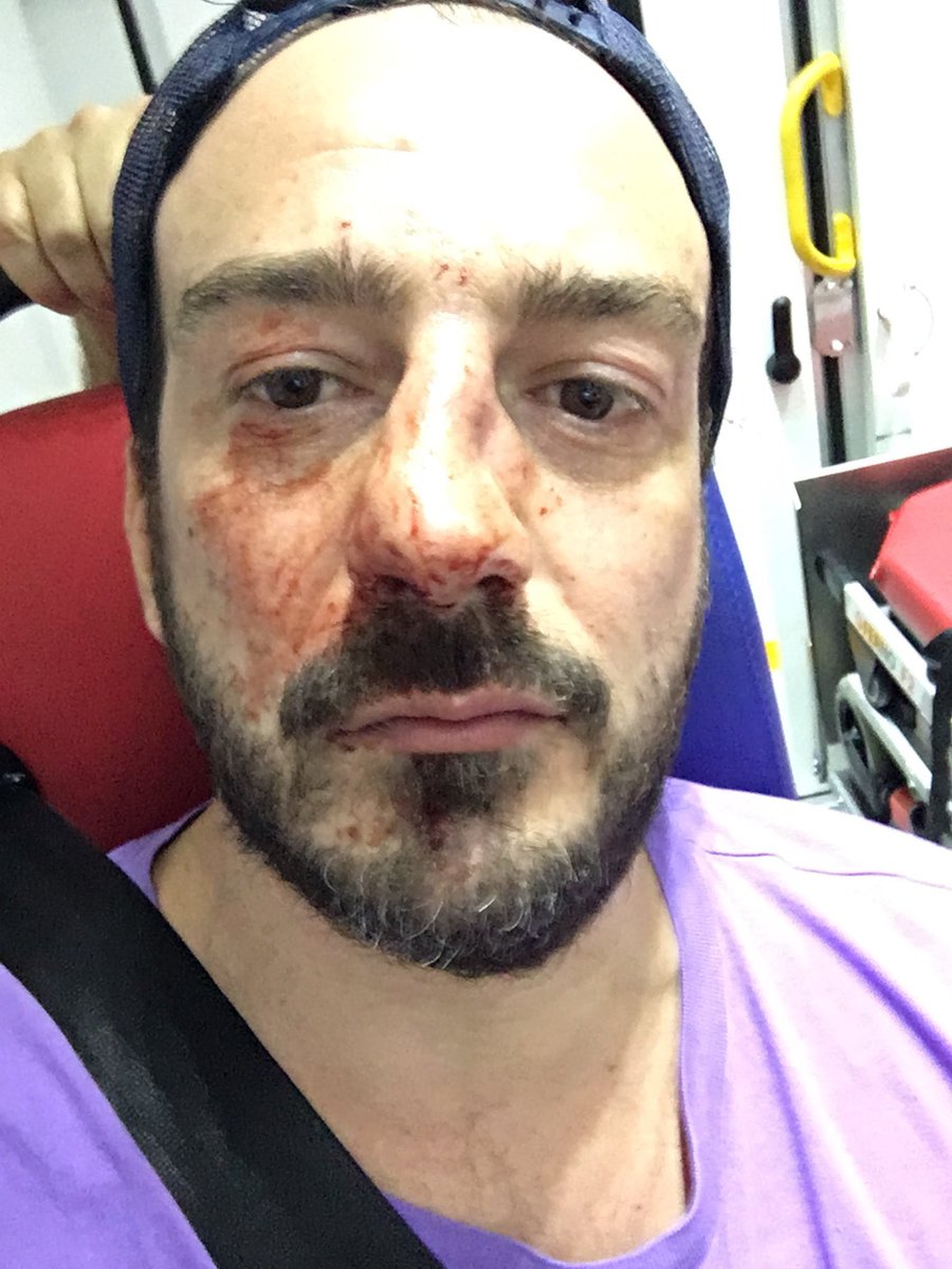 Christophe Beaugrand-Gerin (@tof_beaugrand) on Twitter photo Catastrophé par le drame vécu par mon ami @Guillaumelanie hier soir, victime d’une scandaleuse agression homophobe en pleine rue !! C’est le président de l’association <a href="/UHomophobie/">Urgence Homophobie 🏳️🌈</a> , il ne pensait pas expérimenter lui-même cette violence qu’il dénonce.
Merci de le soutenir 😘❤️ Catastrophé par le drame vécu par mon ami @Guillaumelanie hier soir, victime d’une scandaleuse agression homophobe en pleine rue !! C’est le président de l’association <a href="/UHomophobie/">Urgence Homophobie 🏳️🌈</a> , il ne pensait pas expérimenter lui-même cette violence qu’il dénonce.
Merci de le soutenir 😘❤️