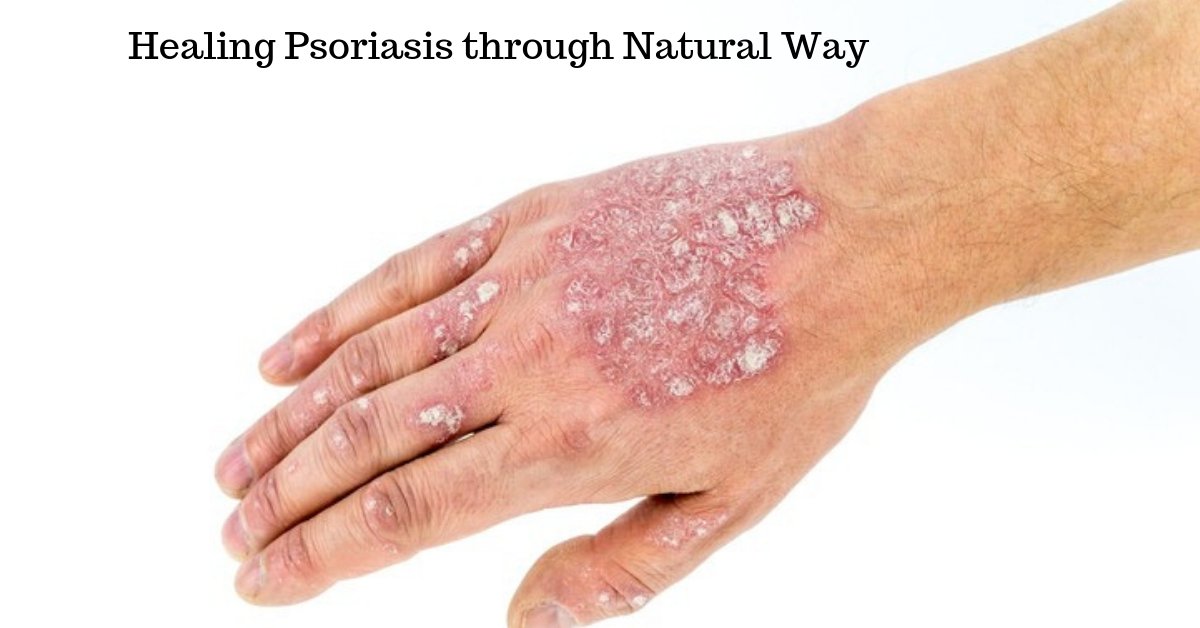 dynamichomeopat's tweet photo. Healing Psoriasis through Natural Way :- https://t.co/LehxkmWCYi
#Healing_Psoriasis through #Natural_Way https://t.co/hWP78sOahD