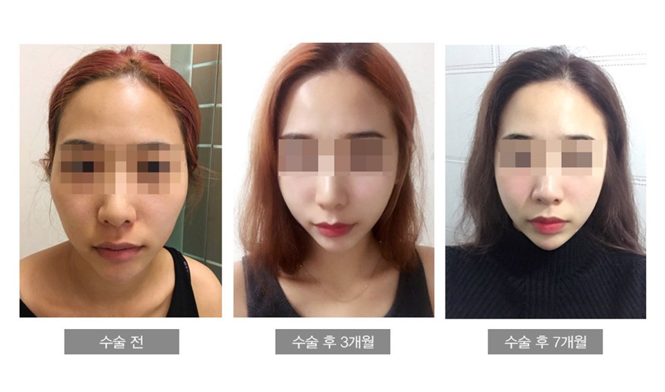 Kokoro Twitter પર 凸凹からなめらかな卵型に大変身 顔の小ささとフェイスラインの綺麗さがとても羨ましいです 気になる方は いつでもお気軽にお問い合わせください Line Kokorokorea 韓国美容整形 美容外科 美容整形手術 輪郭手術 小顔整形